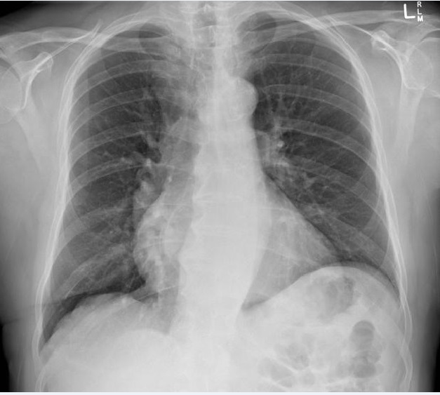M.S chest X-ray.jpg