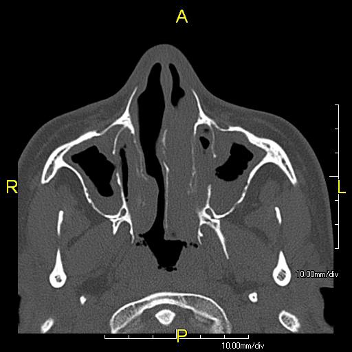 Axial CT image showing chronic sinusitis in a patient with Kartagener syndrome.
