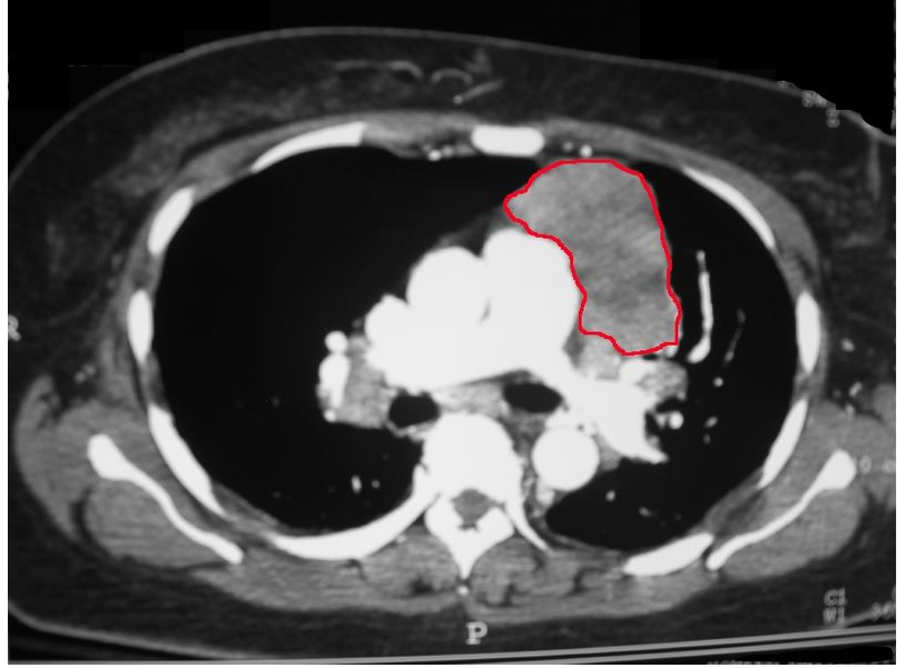 CT scan of the chest revealing a large necrotic mass in the left anterior mediastinum (later proven to be a thymoma) and bilateral hilar lymphadenopathy