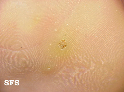 Warts plantaris. Adapted from Dermatology Atlas.[1]