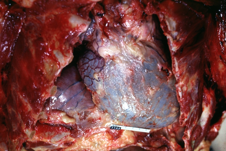 Hemopericardium: Gross, in situ, unopened pericardium (a very good example)