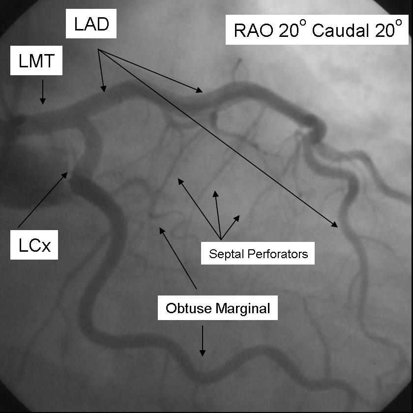 A coronary angiogram that shows the LMCA, LAD and LCX