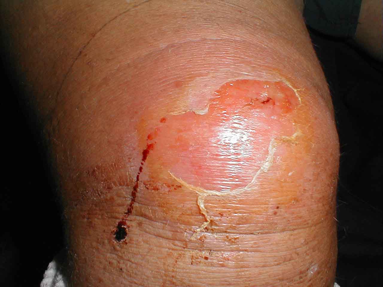 Prepatellar Bursitis: Redness and swelling of prepatellar bursa caused by bacterial infection. Inflammation and edema have led to desquamation.