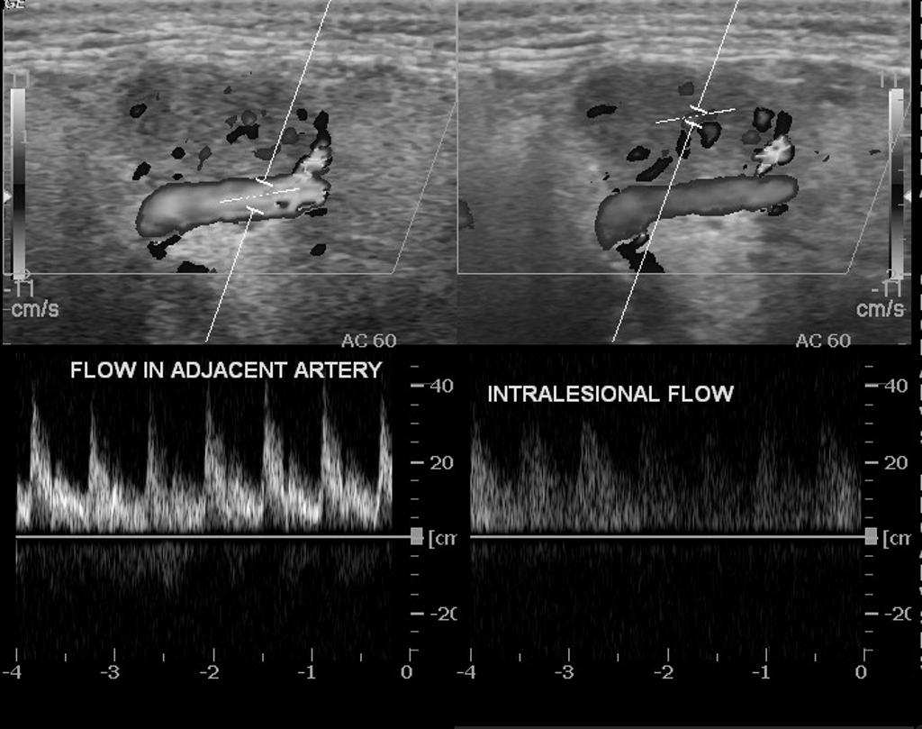 Ultrasound showing submandibular gland lesion[7]