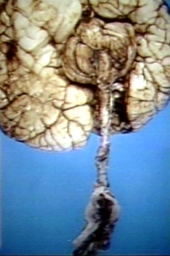 Brain: Arnold Chiari Malformation with Myelocele