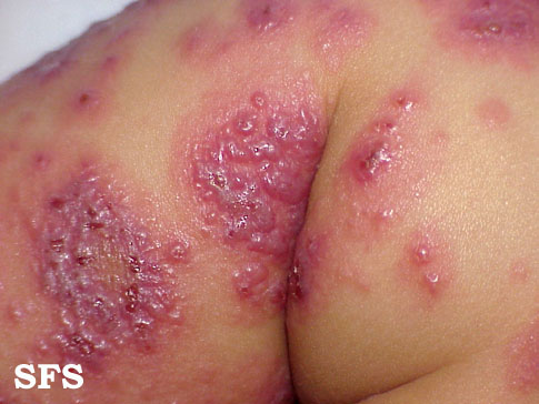 File:Eczema herpeticum08.jpg