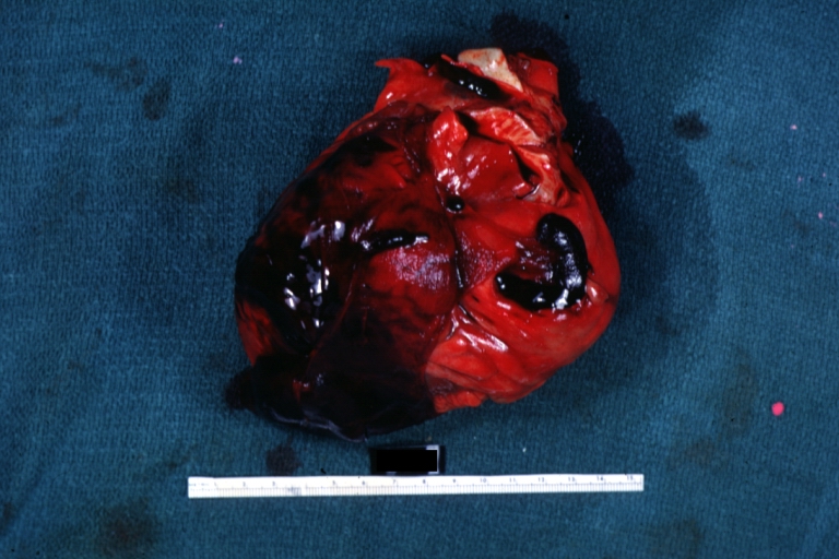 Hemopericardium due to Needle Puncture: Gross, natural color, external view of heart covered by blood