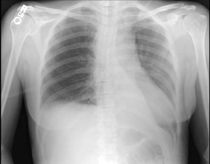 Atelectasis chest x ray - wikidoc