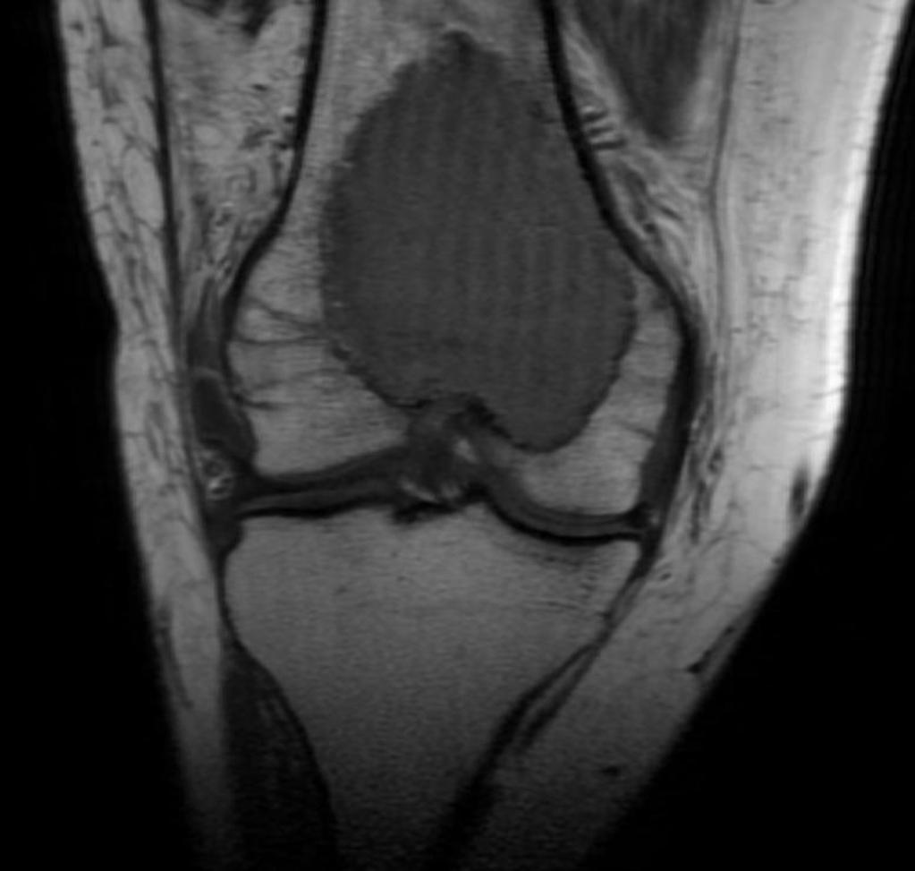 File:MRI giant-cell-tumour-femur.jpg