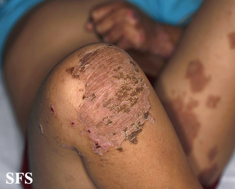 Acrodermatitis enteropathica. With permission from Dermatology Atlas.[1]