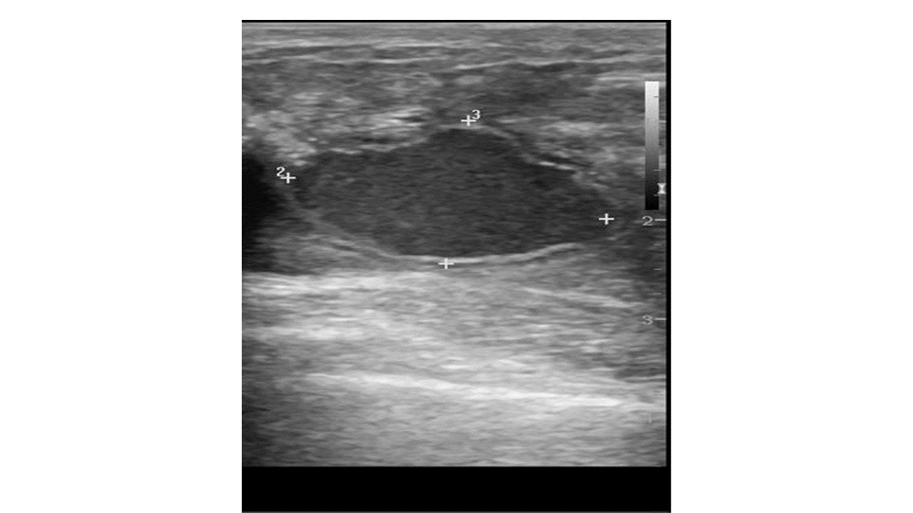 Breast Abscess Ultrasound Wikidoc