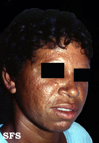 File:Lepromatous leprosy11.jpg