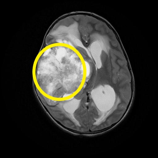 File:Primitive-neuroectodermal-tumour-of-the-cns-1.jpg