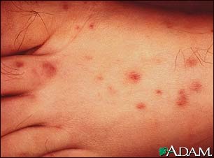 Rocky Mountain spotted fever is caused by the organism Rickettsia rickettsii and is transmitted by a tick bite. It is a serious infection that produces a classical rash in about 90% of infected individuals. This is the typical appearance of the rash. There are many symptoms that affect the entire body (systemic)