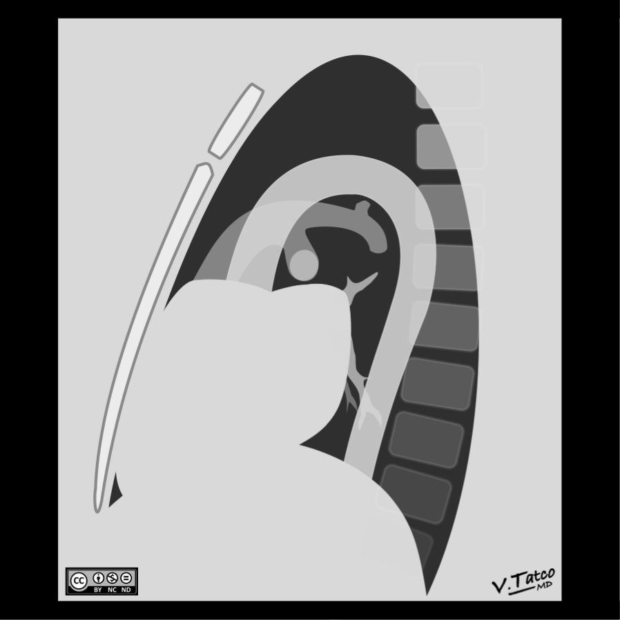 File:Right-ventricular-enlargement-on-chest-radiography-illustration lateral view.png
