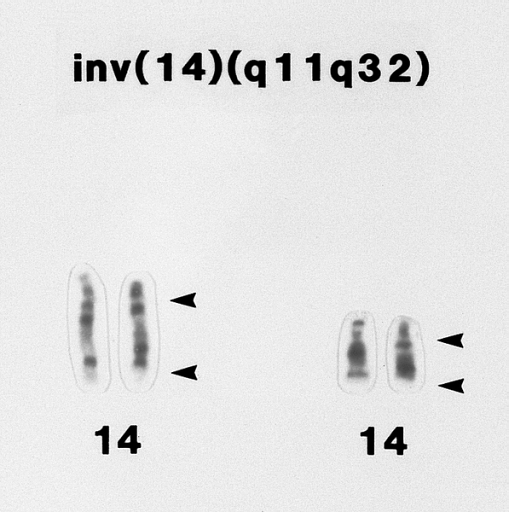 T-prolymphocytic leukemia. Portion of a karyotype of a lymphocyte from the specimen shown in B showing an inv(14)(q11q32) abnormality. (G banded, Wright-Giemsa stained)