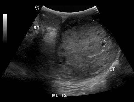 File:Ultrasound choriocarcinoma.jpg