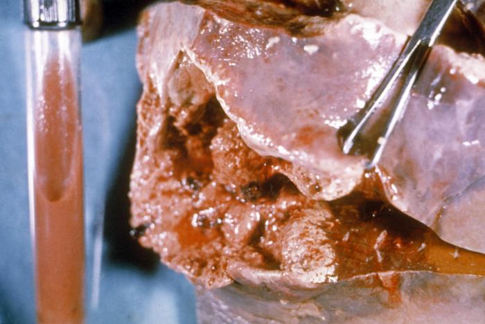 Amebic abscess of liver. Adapted from Public Health Image Library (PHIL). [8]