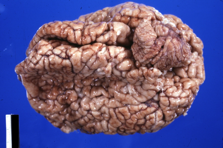 Brain: Arnold Chiari Malformation And Polygyria: Gross fix tissue external view