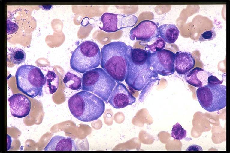 Bone marrow in multiple myeloma. (Image courtesy of Melih Aktan M.D.)