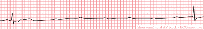 Short lasting total AV block. P waves are present, but not followed by QRS complexes