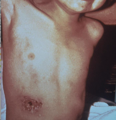 Ulcerated skin lesion at a plague inoculation site caused by the Gram-negative bacterium, Yersinia pestis. From Public Health Image Library (PHIL). [18]