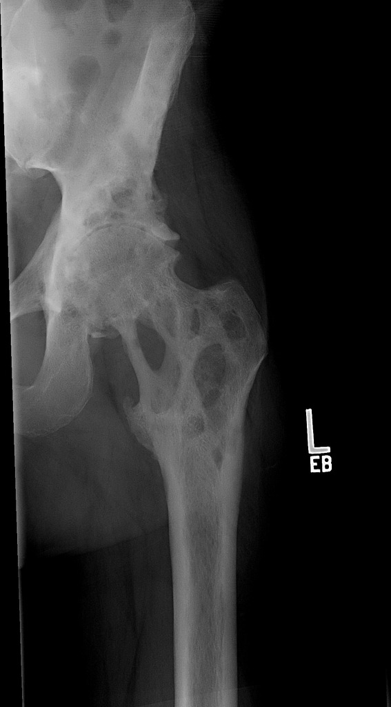 Severe uniform joint space narrowing of the left femoroacetabular joint with moderate osteophytosis[1]