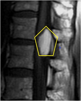 File:Spinal-intramedullary-lipoma.jpg