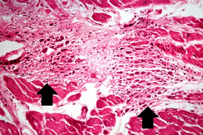 This is a higher-power photomicrograph of myocardium containing Aschoff bodies (arrows) within the interstitium.