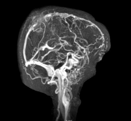 Meningioma angiography demonstrating dural sinus invasion[4]