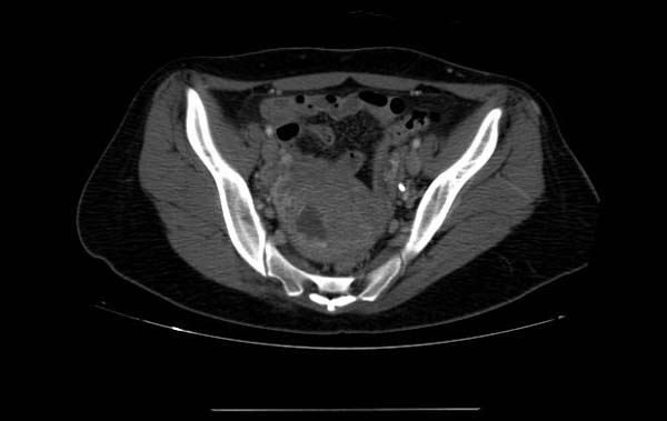 Gravid-uterus-CT-002.jpg