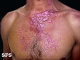 Lupus Erythematosus Chronicus Disseminatus Superficialis. Adapted from Dermatology Atlas.[30]