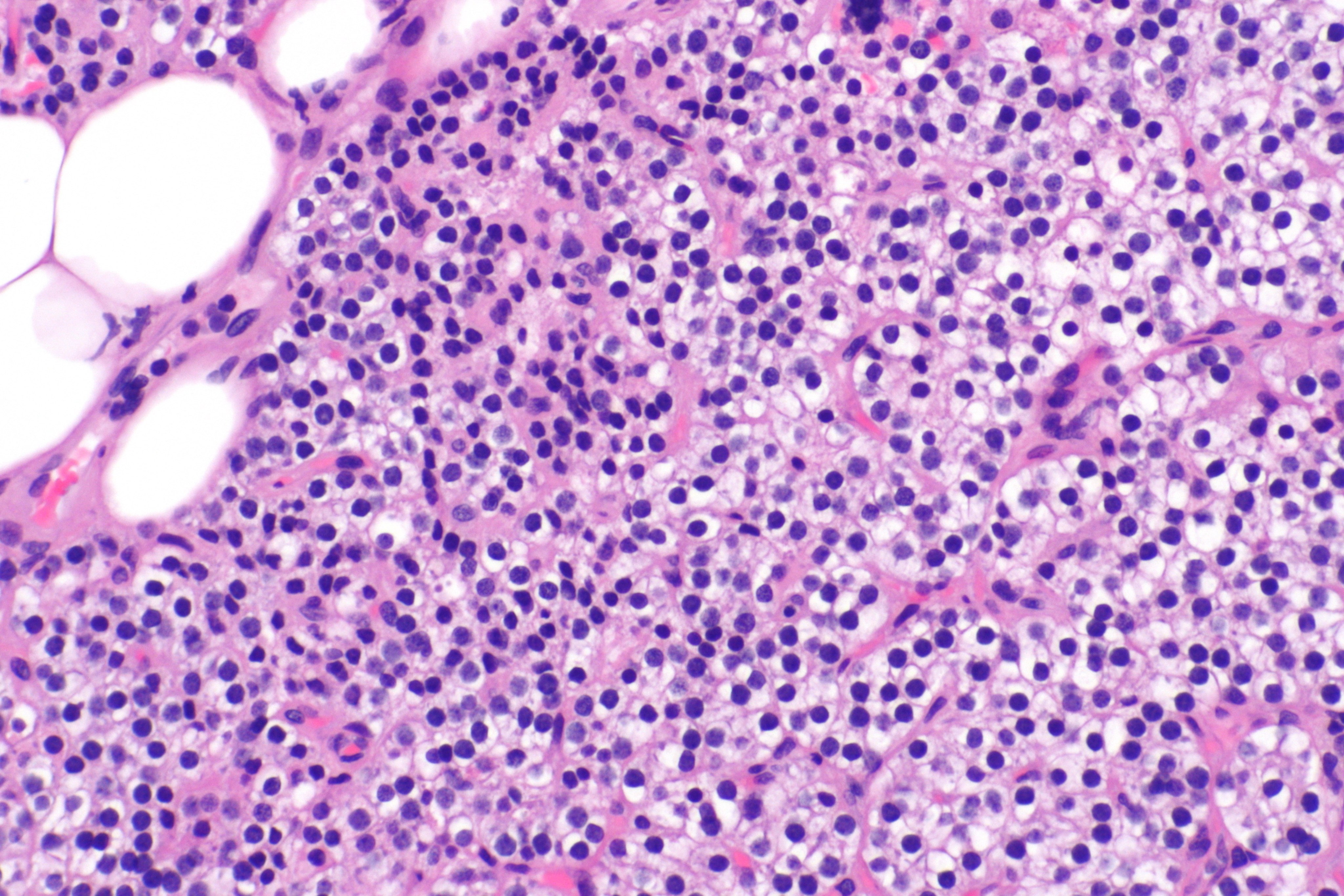 Micrograph showing a parathyroid hyperplasia (H&E stain) on high magnification.Parathyroid adenoma is a clinicopathologic diagnosis. The histology is nonspecific. - Source: Wikimedia commons