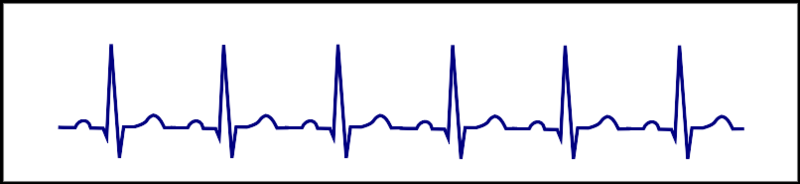 Palpitation electrocardiogram - wikidoc