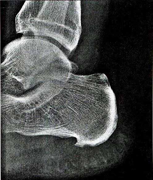 File:Xray osteoporotic heel2.jpg