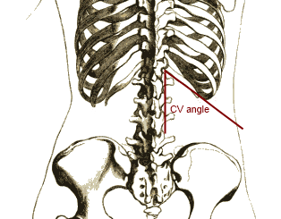 Picture depicting Costovertebral angle.