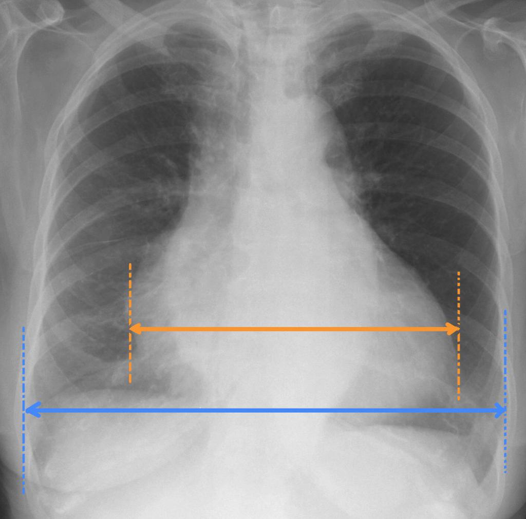 File:Cardiomegaly-3.jpg
