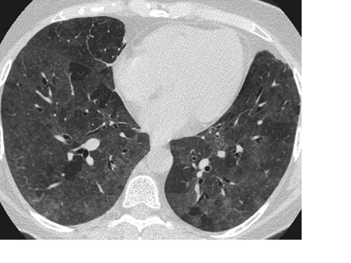 File:Flock workers Lung Ct scan.jpg