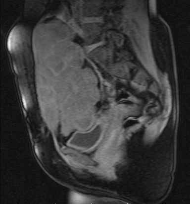 MRI of desmoid tumor