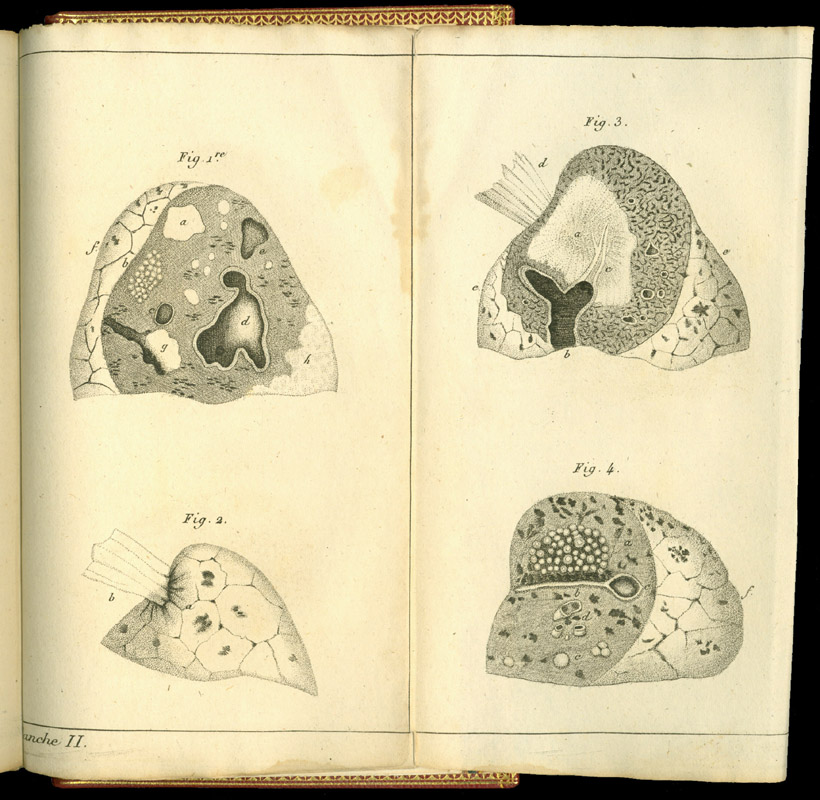 File:Rene-Theophile-Hyacinthe Laennec (1781-1826) Drawings diseased lungs.jpg