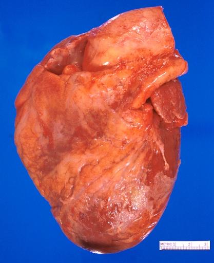 Heart, acute myocardial infarction, 6 days old, in a patient with diabetes mellitus and hypertension