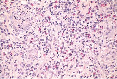 File:Drug-induced interstitial nephritis, with prominent eosinophilic.png