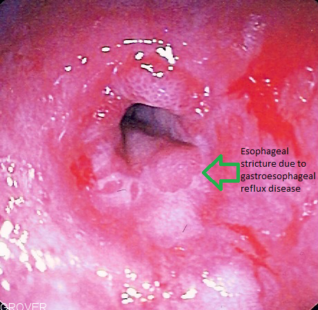 File:Esophageal stricture due to GERD.png