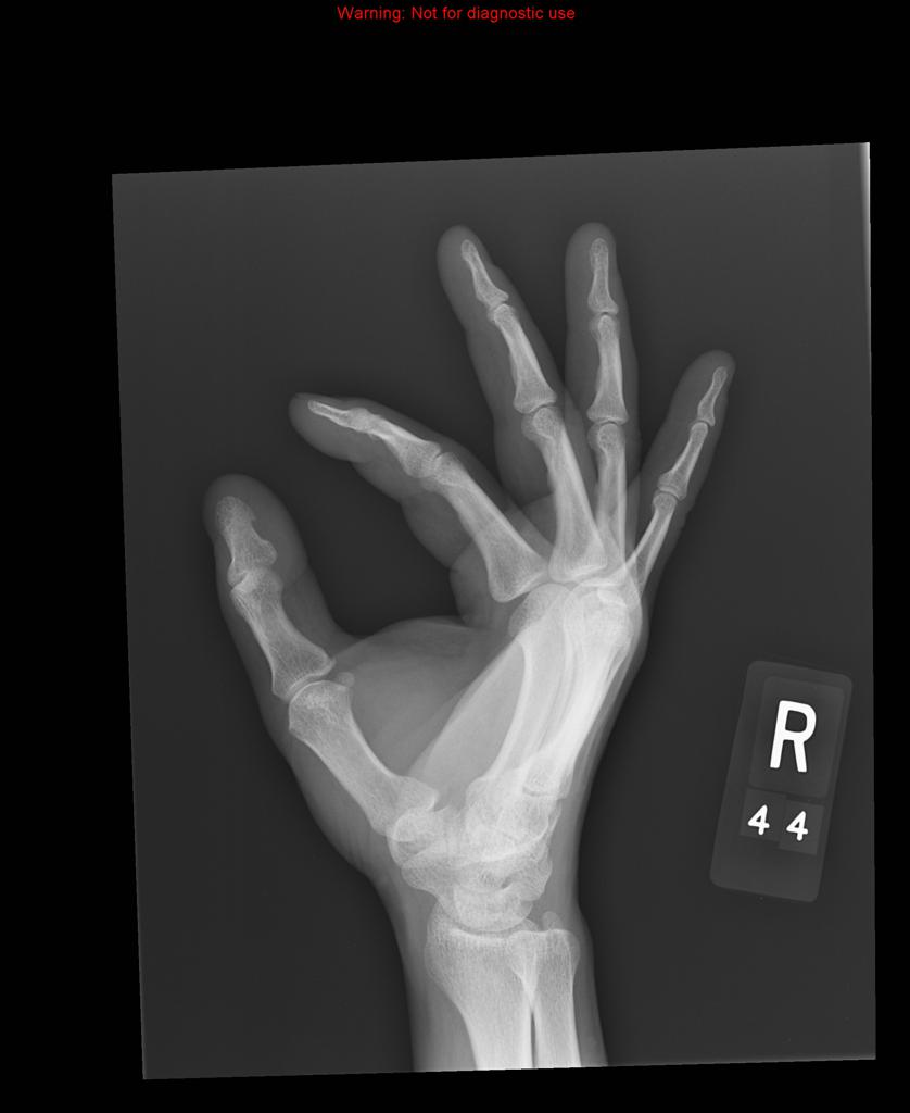 Small ship fracture noted at the ulnar aspect of the base of first phalanx.