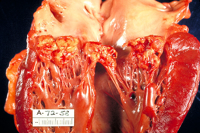 Gross pathology of subacute bacterial endocarditis involving mitral valve. From Public Health Image Library (PHIL). [4]