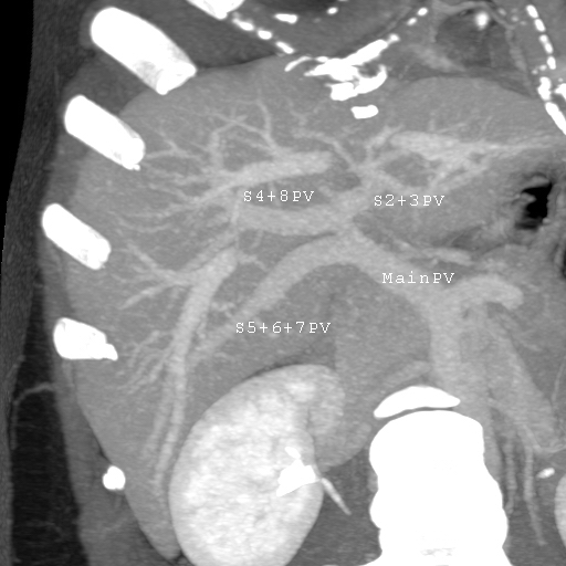 MDCT image. Portal venous anatomy contraindicated for liver donation.