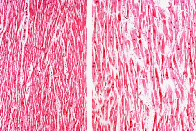 This low-power photomicrograph shows normal myocardium (left) compared to hypertrophied myocardium (right).