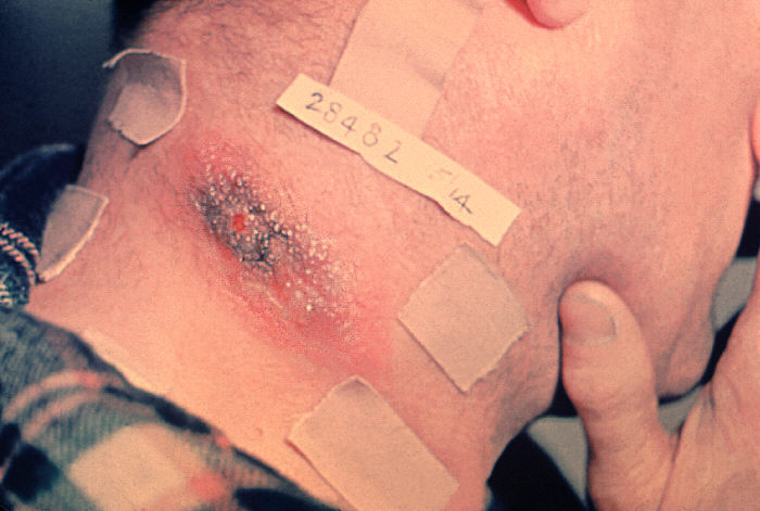 "Cutaneous anthrax lesion on neck of man”Adapted from Public Health Image Library (PHIL), Centers for Disease Control and Prevention.[3]