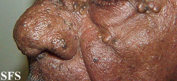 url = http://www.atlasdermatologico.com.br/disease.jsf?diseaseId=146>