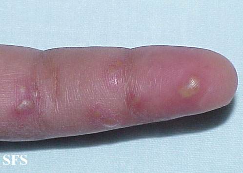 File:Herpes simplex 14.jpeg